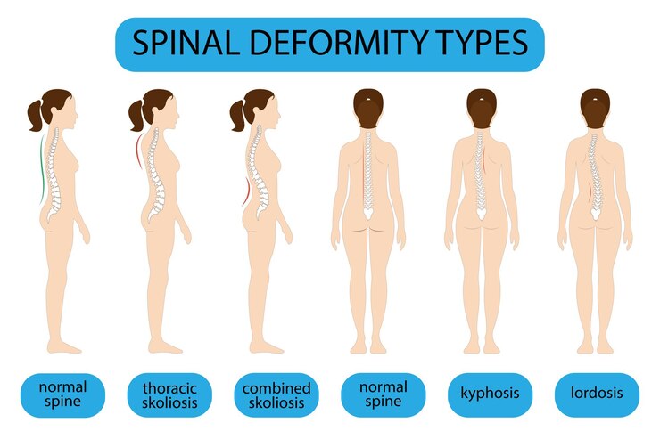 Vector spine deformation types and healthy spine comparison diagram poster with backbone curvatures