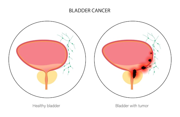 Vector stadia van blaaskanker