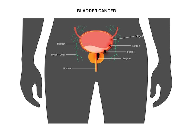 Vector stadia van blaaskanker