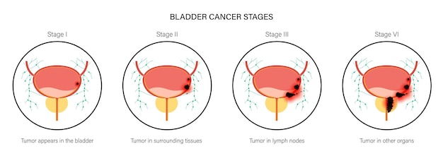 Vector stadia van blaaskanker