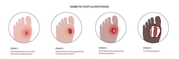 Stadia van het diabetische voetsyndroom Diepe zweer, open zweer of wond aan de voeten Ontsteking van de ligamenten, pezen en botten Gangreeninfectie en amputatie Pijn in de benen, diagnostische en behandelingsvector