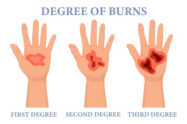 Stadia verbranden. Verbrande handen in verschillende gradaties. Symptomen van brandwonden op de huid. Medisch zorgconcept. Vector