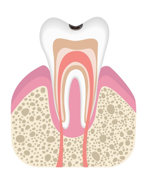 벡터 충치 발달의 단계 플랫 스타일의 치아 구조 법랑질 치과 질환 현실적인 벡터 일러스트와 함께 충치