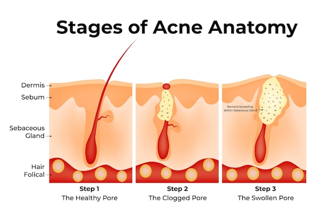 stages of acne anatomy dermis sebum sebaceous gland hair folical the healthy pore clogged
