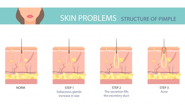 Stages of the acne formation on human skin.