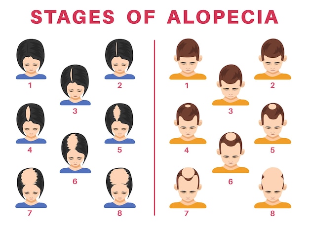 Fasi di alopecia nel set di illustrazioni di uomini e donne