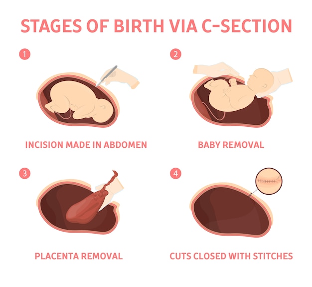 Stages of baby birth via cesarean section . Fetus movement during the c-section. Biology and gynecology.   illustration