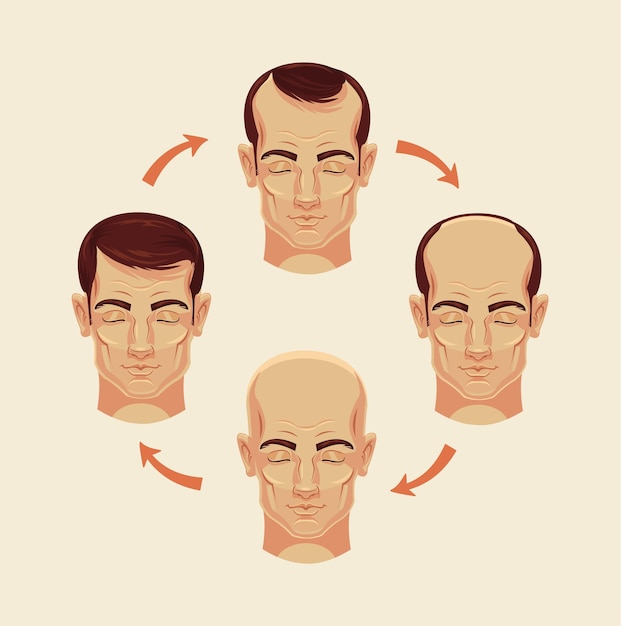 Stages of baldness flat cartoon illustration