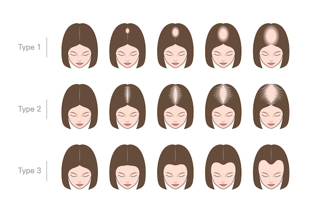 stages of baldness of women female character top view with hair loss process types of alopecia
