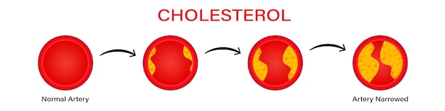 Vector stages cholesterol formation in erythrocytes clipart filling red blood cells with yellow thrombus and building up atherosclerotic vector plaques