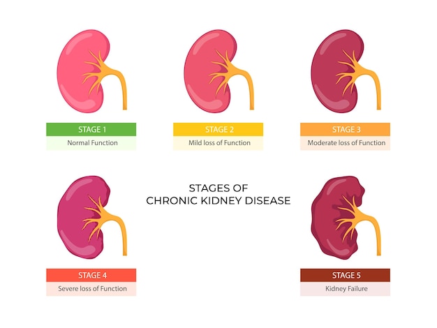 Stages of chronic kidney disease Problem in urinary system and normal kidney