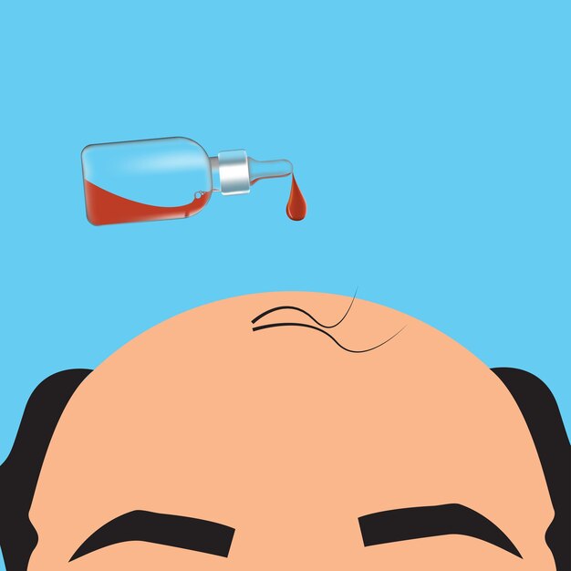 Vector stages of hair loss men treatment and transplantation vector illustration