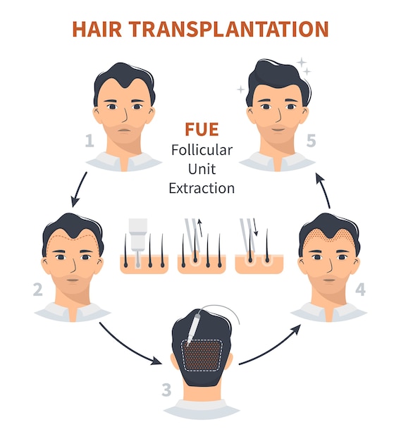 Vector stages of hair transplantation fue follicular unit extraction