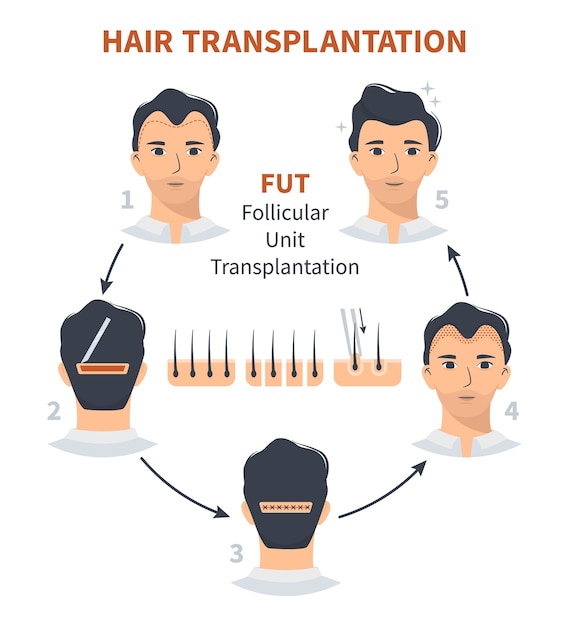 Stages of hair transplantation fut follicular unit