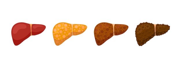 Stages human liver damage concept. Healthy liver steatosis fatty NASH fibrosis and cirrhosis. Vector cartoon medical reversible and irreversible condition illustration