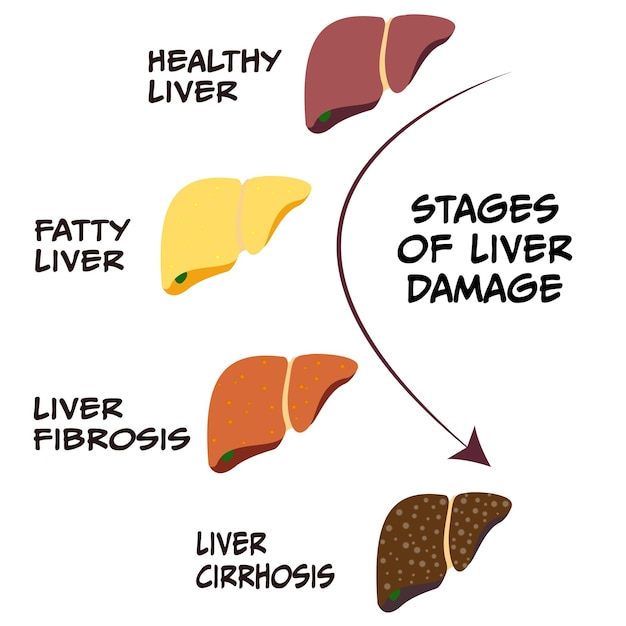 Vector stages of liver damage diagram of disease progression