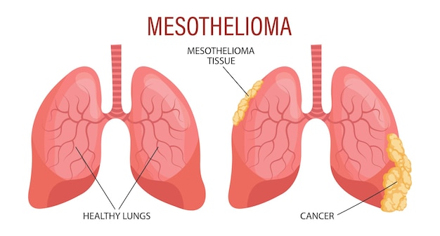 Vector stages of mesothelioma lung disease healthcare medical infographic banner illustration vector