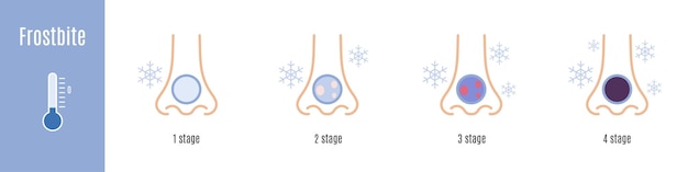 Вектор Стадии обморожения носа. переохлаждение. медицинская инфографика