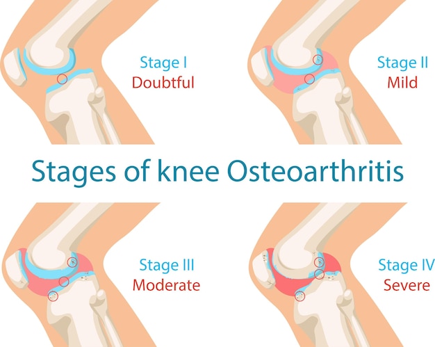 Stages of osteoarthritis of the knee.