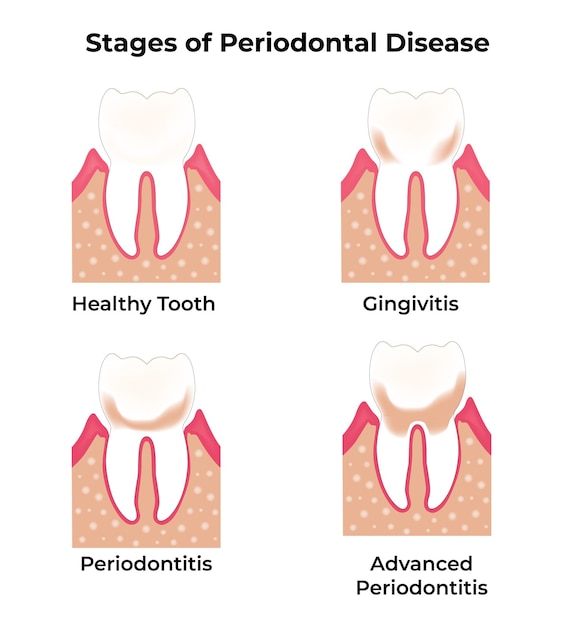 Stages of Periodontal Disease Healthy Tooth Gingivitis Periodontitis Advanced Periodontitis