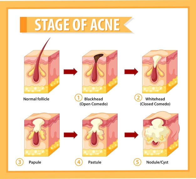 Vettore fasi dell'anatomia della pelle dell'acne