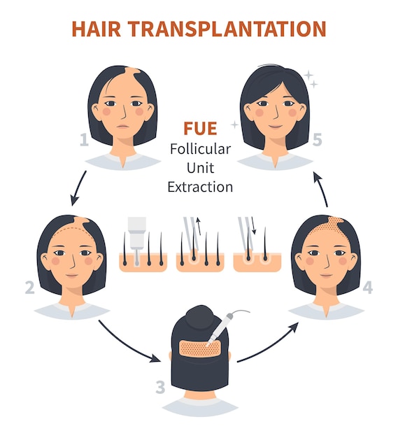 Vector stages of woman hair transplantation fue follicular unit extraction