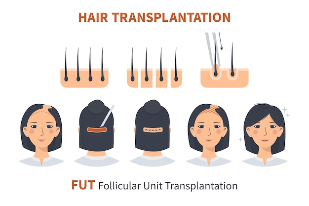 Vector stages of woman hair transplantation fut follicular unit