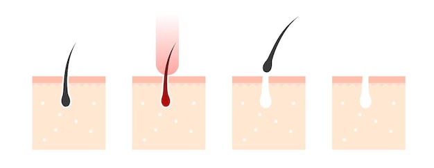 Stappen van laserhaarverwijdering proces van laserepilatie infografiek menselijke huid en haarfollikels vector