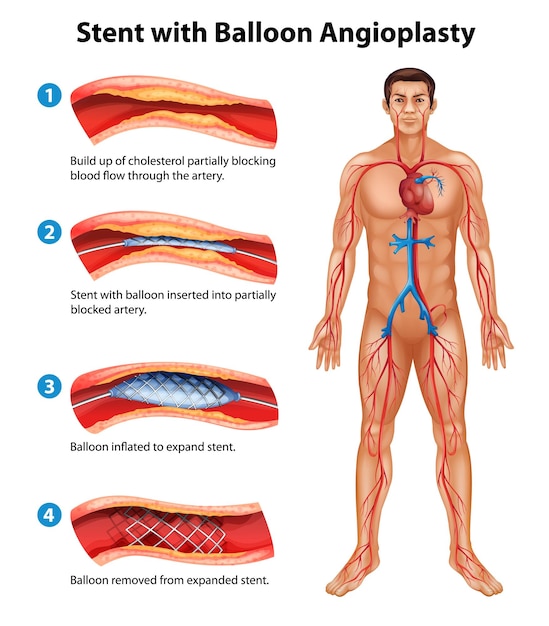 Vector stent angioplasty procedure