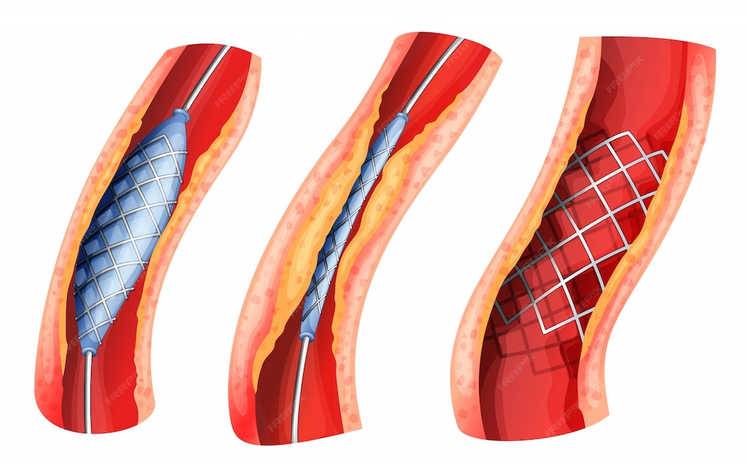 Stents
