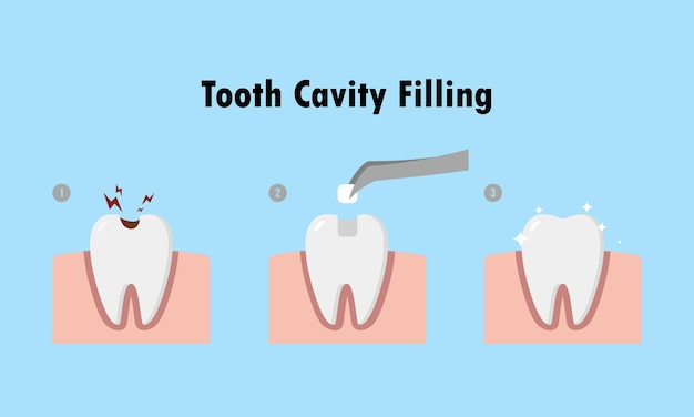 Step of restoring cavity tooth by filling tooth illustration cartoon character vector design on blue