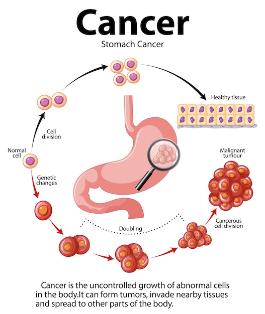 Vector stomach cancer abnormal cell growth infographic
