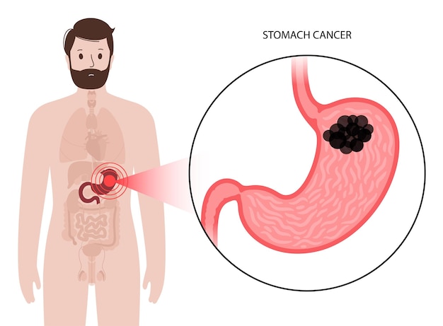 Stomach cancer concept