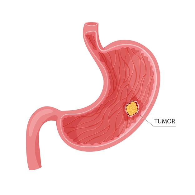 Cancro dello stomaco tumore canceroso maligno illustrazione vettoriale anatomica isolata sullo sfondo bianco stile cartone animato