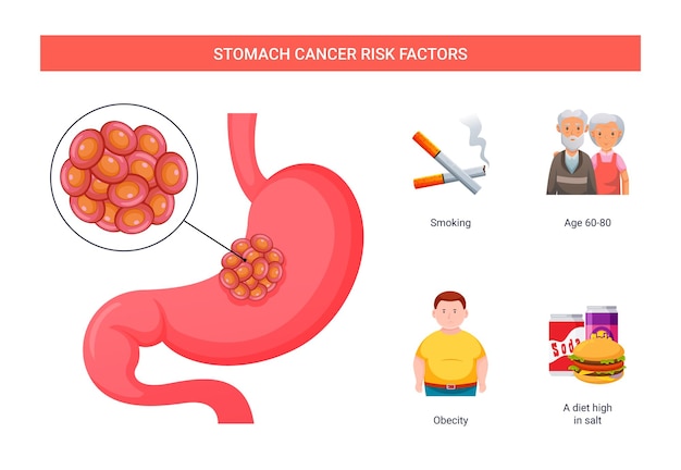 Vector stomach cancer risk factors infographic