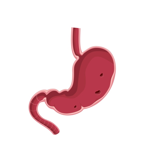 Stomach cross section erosive gastritis