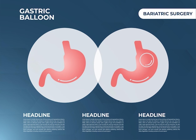 Palloncino gastrico per endoscopia dello stomaco all'interno di un'illustrazione vettoriale di un intervento chirurgico per la perdita di peso dello stomaco obesità