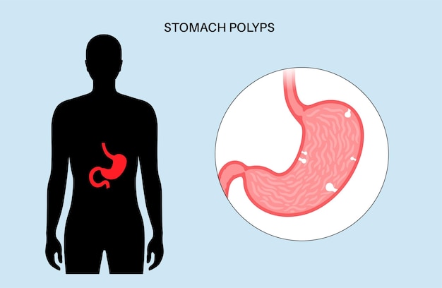 Stomach polyp disease