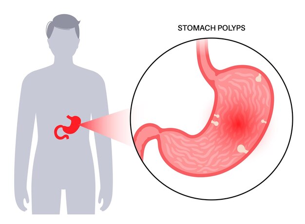 Infusiones prohibidas para la gastritis