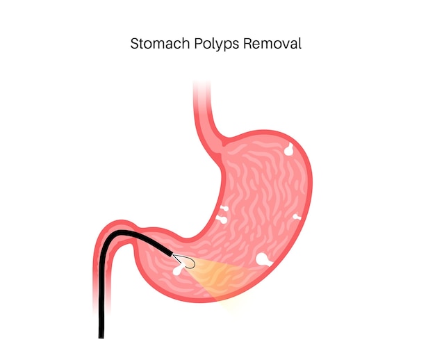 Rimozione del polipo dello stomaco