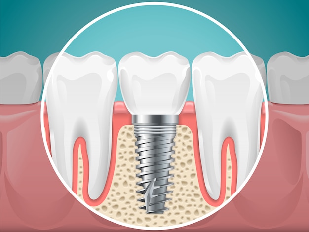 Stomatology illustrations. dental implants and healthy teeth. vector health tooth and implant stomatology, dentistry installation and fixture