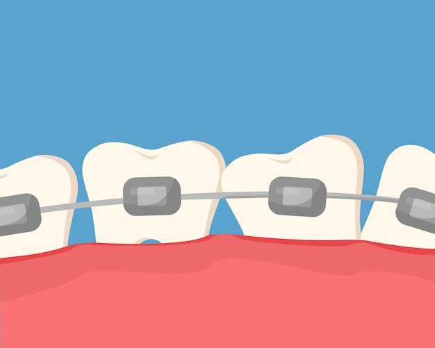 벡터 교정기로 비뚤어진 치아 교정 교정 치료 벡터 만화