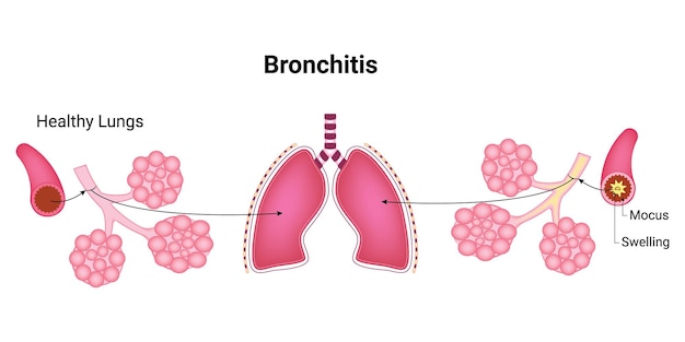 Структура бронхита медицинское образование чертежная диаграмма человеческих легких векторная иллюстрация