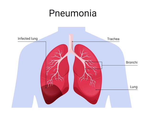 Structuurdiagram van longontsteking