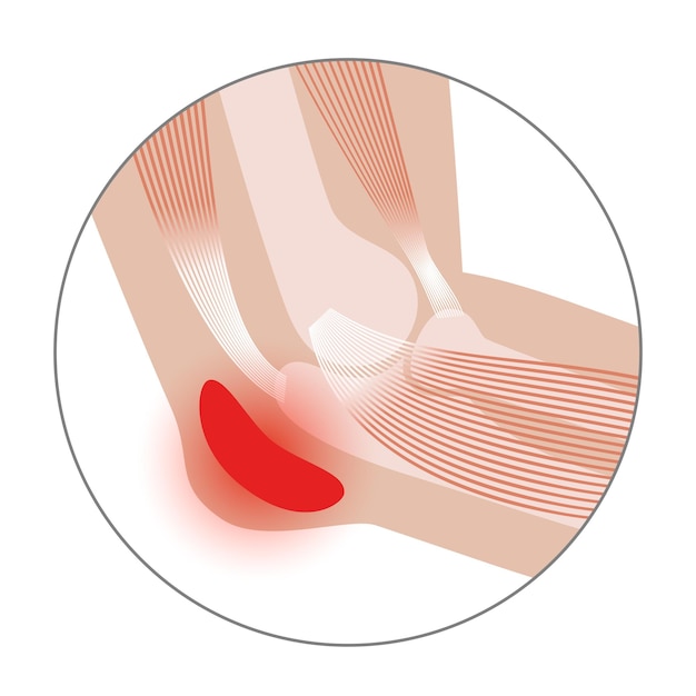 Vector student elbow bursitis