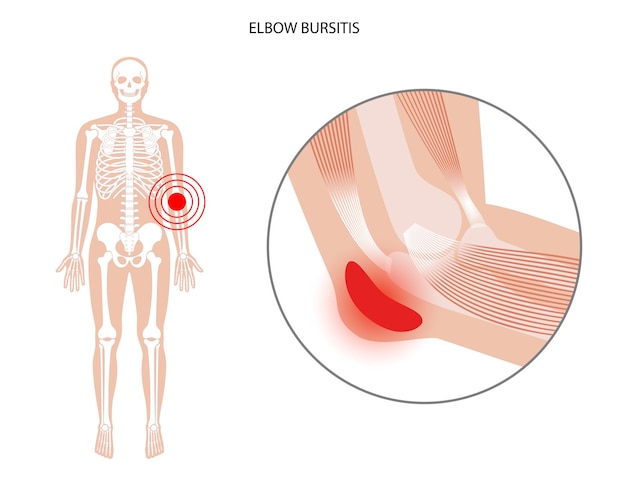 Vector student elbow bursitis