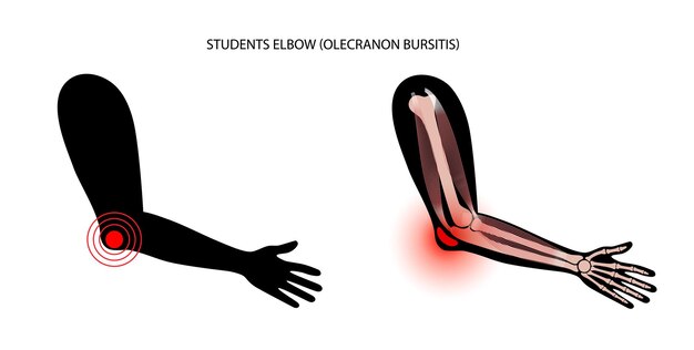 学生の肘頭部滑液包炎