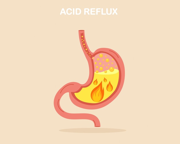 Suffering from GERD with acid reflux Stomach heartburn with burning acid inside Digestive system