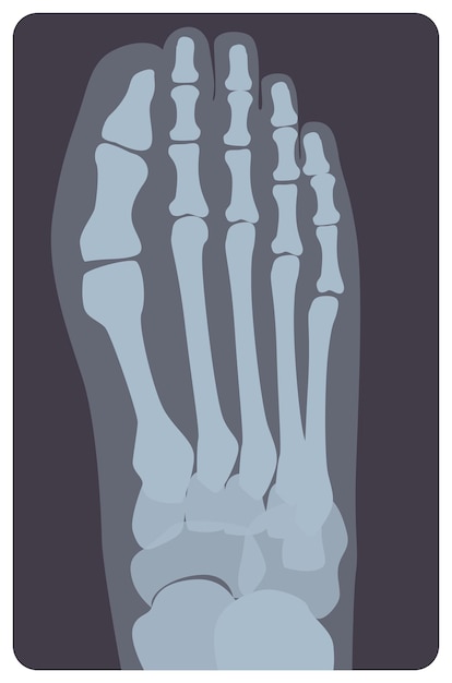 Vettore radiografia superiore del piede o dell'arto destro umano. immagine a raggi x o immagine del monitor radiografico delle ossa e delle dita del metatarso, vista dall'alto. radiologia medica. illustrazione vettoriale monocromatica in stile piatto