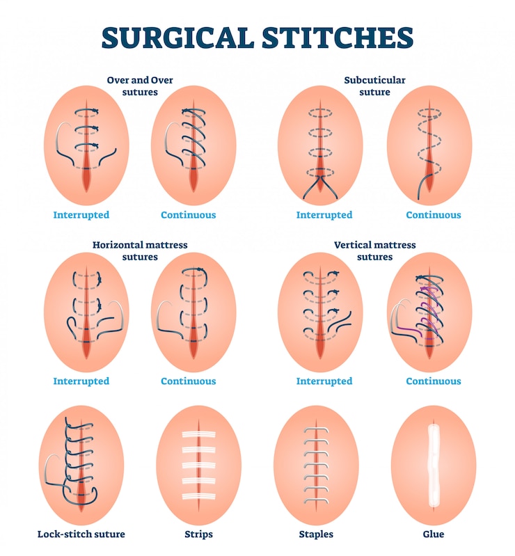 Surgical stitches   illustration. Labeled various cut injury treatment
